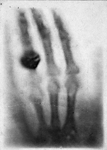 The hand of Anna Berthe Röngten, the very first X-ray radiograph, done on the 22 December 1895.